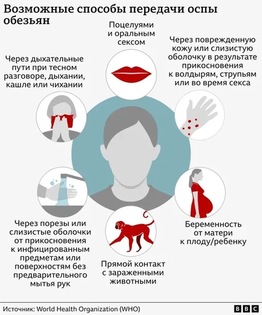 ВОЗ: почему оспа обезьян не станет новой пандемией, как COVID