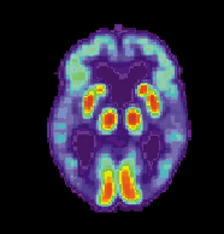 Старение мозга: учёные обнаружили пять разных сценариев угасания разума