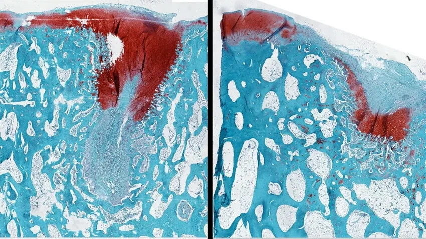 Укол вместо скальпеля: биоматериал для восстановления хряща в суставе