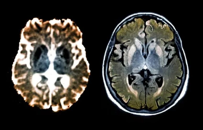 Новый редактор генов остановил смертельные болезни мозга у мышей