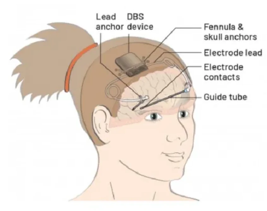 Первый в мире мозговой имплант победил эпилепсию у подростка