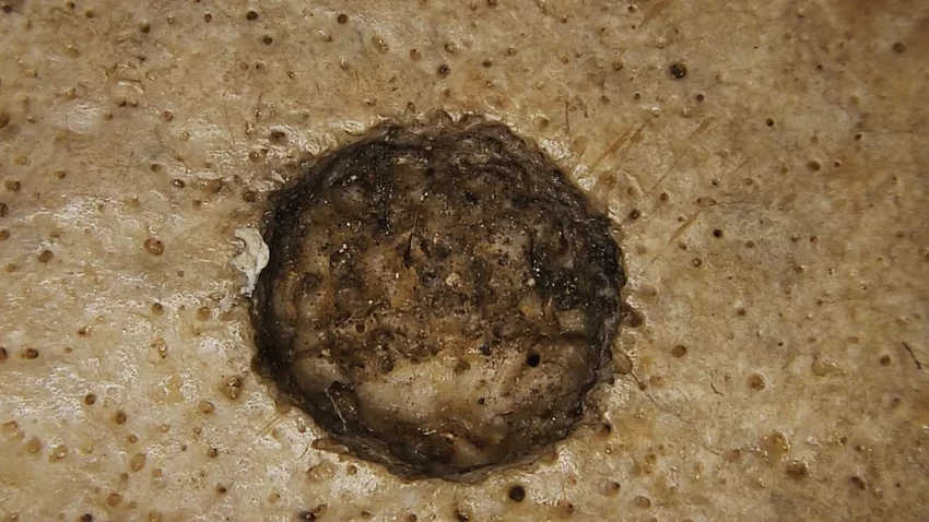 Хирургия рака в Древнем Египте: операции проводили более 4000 лет назад