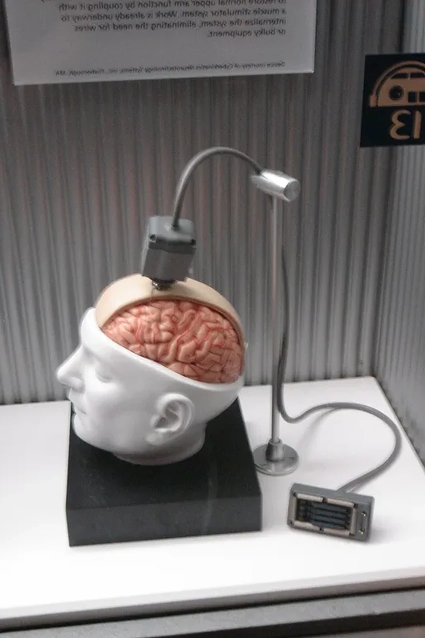 Как мозговой имплант вернул речь и два языка человеку после инсульта