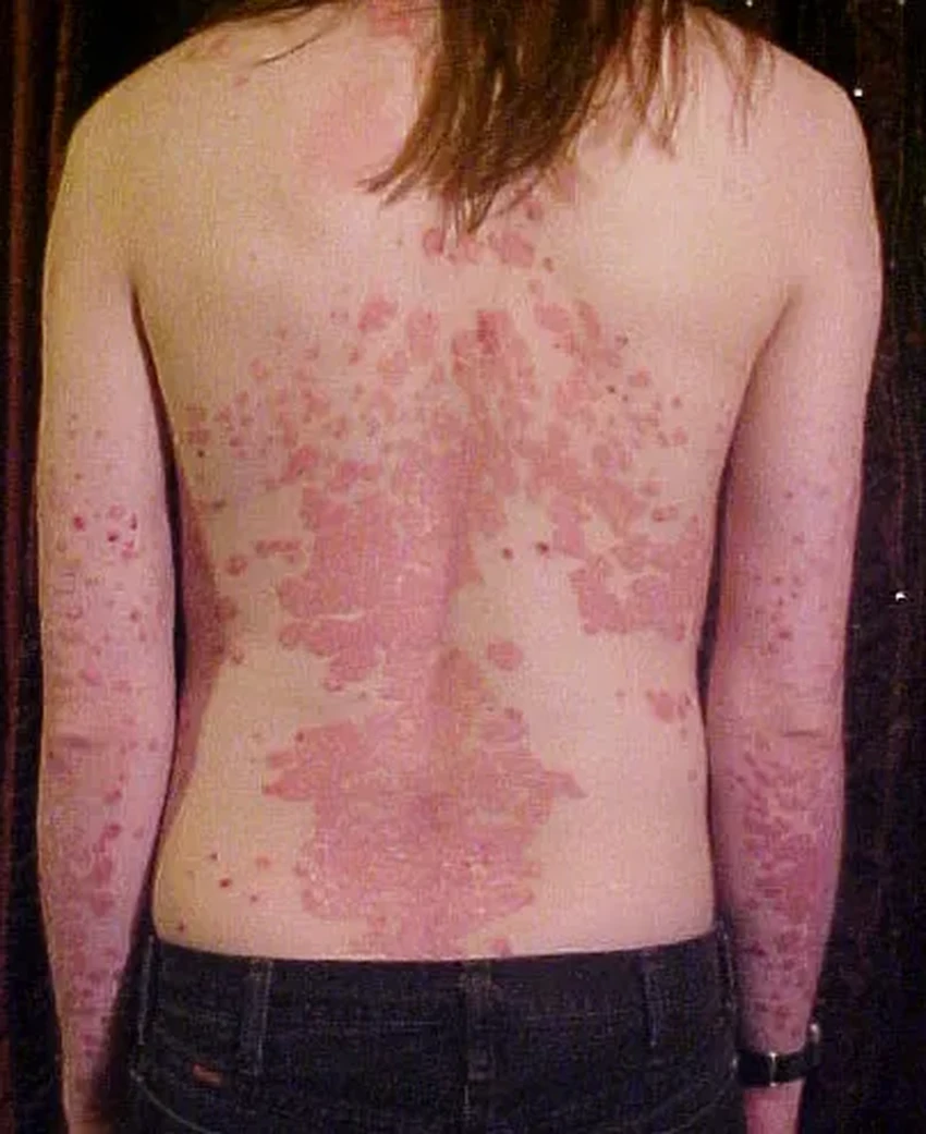 Низкая стрессоустойчивость повышает риск развития псориаза, выяснили ученые