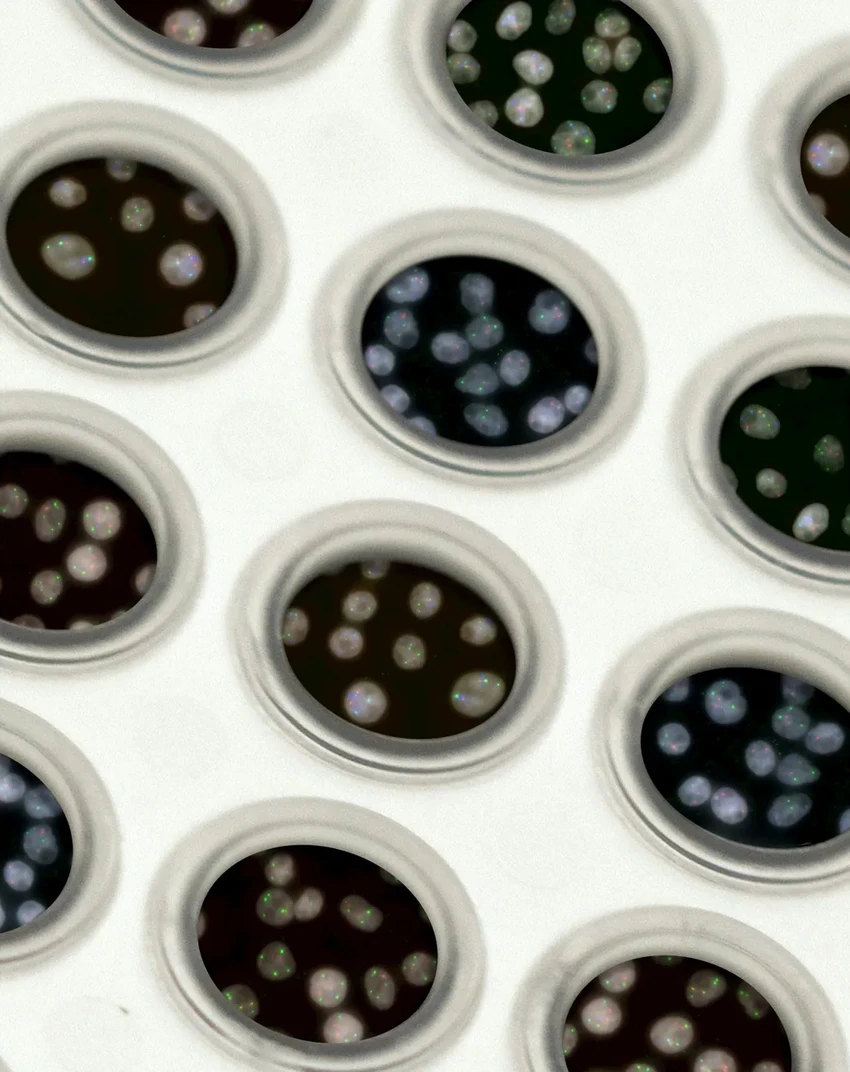 Генетика меланомы: наследственный риск оказался намного выше