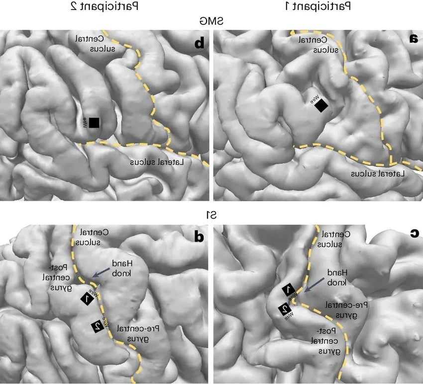 Ученые впервые расшифровали речь из мозга в режиме реального времени
