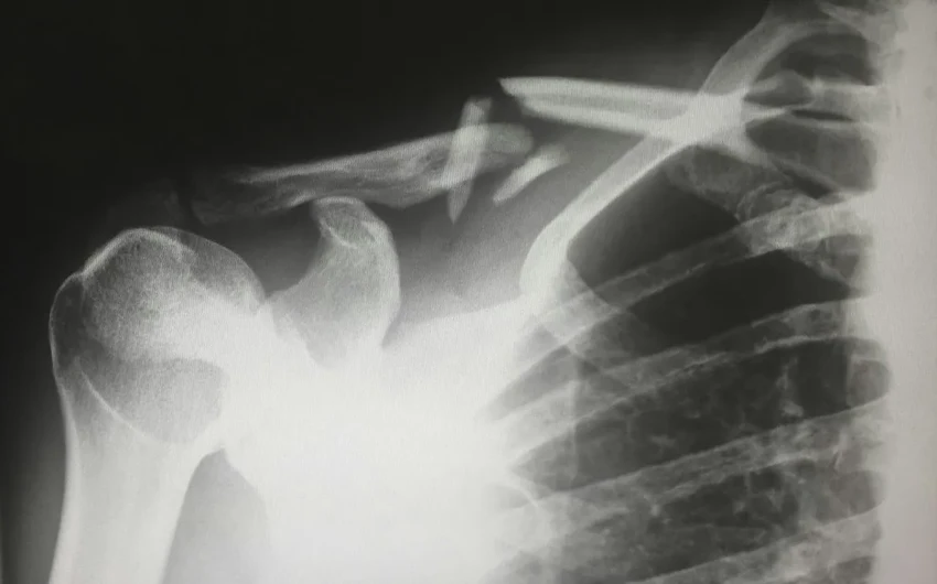 Жир на руках как новый маркер риска переломов позвоночника