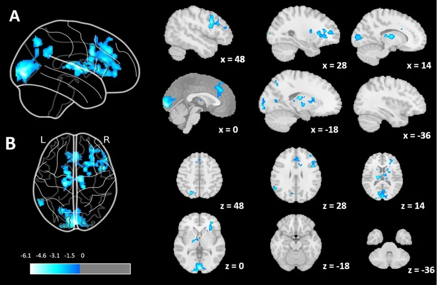 Моменты пустоты в голове: что сканирование мозга показало об «отключении» мыслей