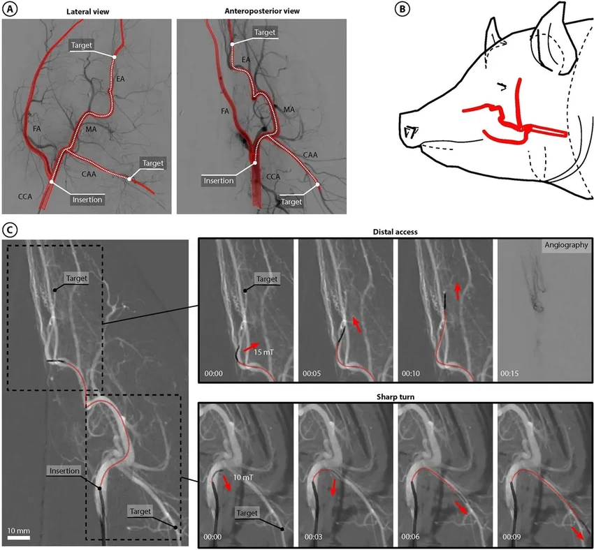 Магнитный робот-спасатель: как он очищает сосуды от тромба при инсульте