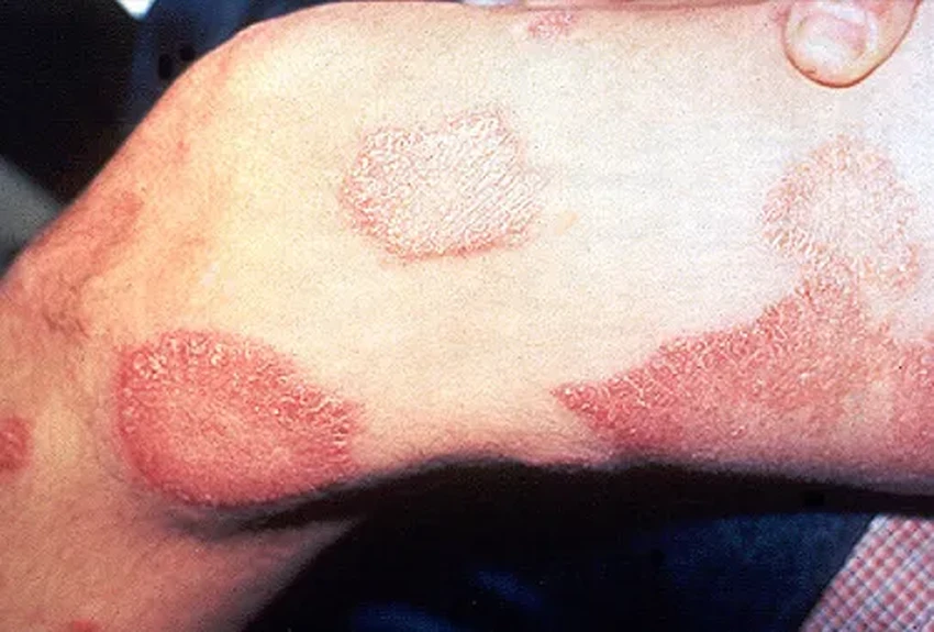 Проказа: тысячелетняя история болезни, которую мы почти победили