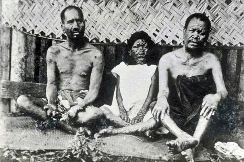 Проказа: тысячелетняя история болезни, которую мы почти победили