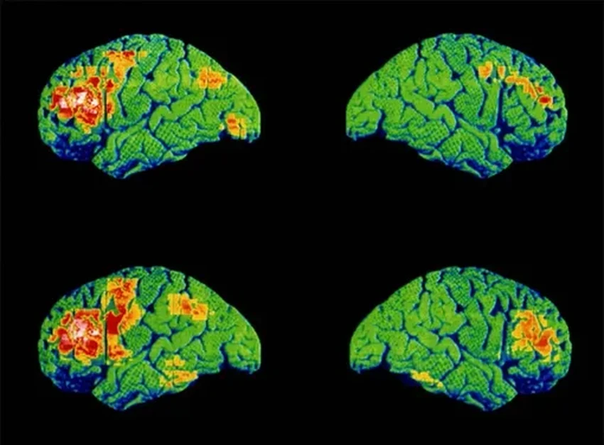 ИИ против шизофрении: почему алгоритмы не справляются с предсказанием терапии