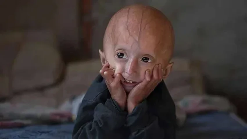 Прогерия: как живут дети, которые стареют в 10 раз быстрее всех
