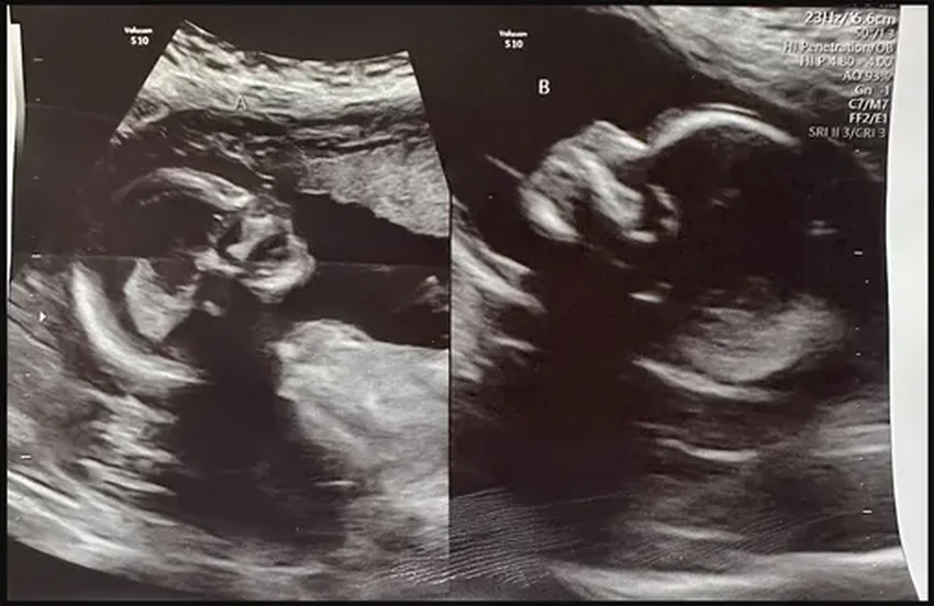 Двойная матка: редкая двойная беременность у жительницы США