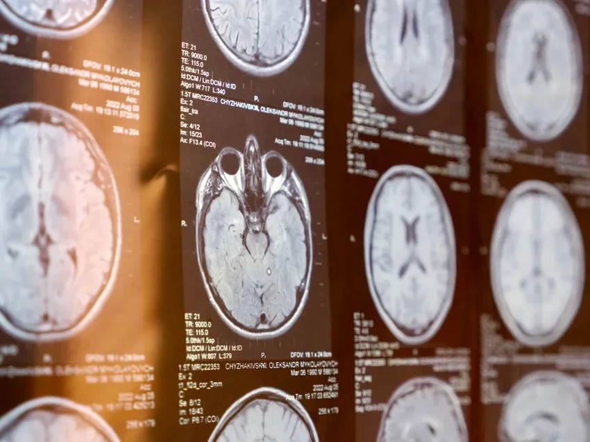 Ожирение ведет к деменции мозга: как лишний вес разрушает сосуды