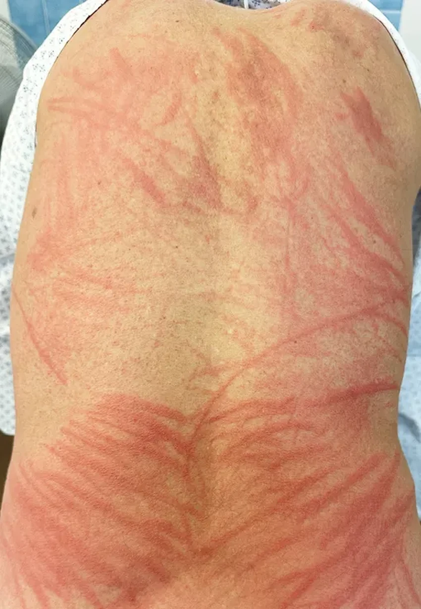 Чем опасны грибы шиитаке: как сырой продукт вызвал тяжелый дерматит