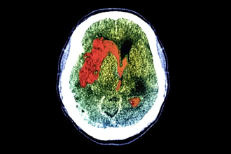 Скрытое сознание: как мозг пациентов в коме реагирует на команды