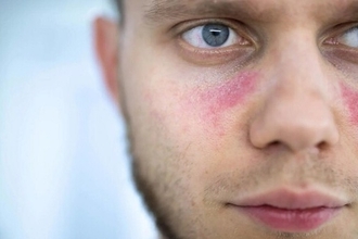 Новое применение CAR T-терапии: лечение волчанки и аутоиммунных болезней