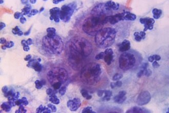 Иммуно-ПЭТ: как увидеть движение лекарства против рака в теле