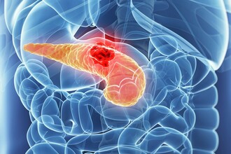 Новая стратегия в борьбе с раком поджелудочной железы: истощение опухоли