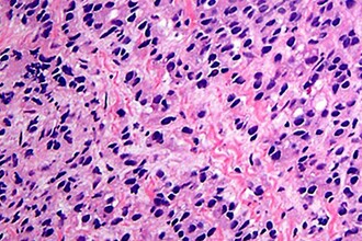 Рак простаты: как новые биомаркеры и точная визуализация меняют диагностику