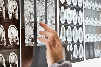 Как томограмма предсказывает риск посттравматического стрессового расстройства