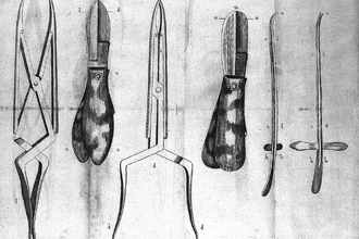 Литотомия: как в прошлом удаляли камни без анестезии и антисептиков