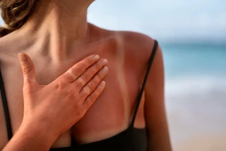 Обгорела и облезает кожа после солнца: как правильно помочь ей восстановиться