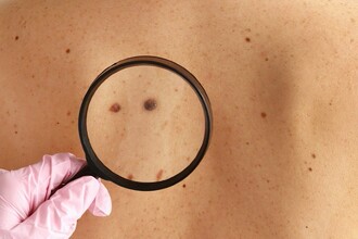 МРНК-вакцина от рака: как первая победа над меланомой меняет всё