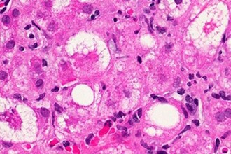 НАСГ: прорыв в лечении жировой болезни печени и новое лекарство