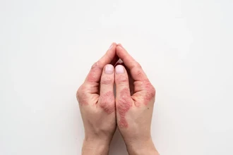 Низкая стрессоустойчивость повышает риск развития псориаза, выяснили ученые