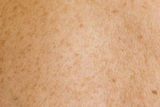 Генетика меланомы: наследственный риск оказался намного выше