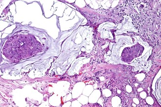 Диагностика рака кишечника: новая технология с точностью 100%
