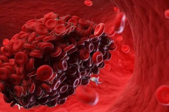 Разрушение тромбов за полчаса: новая технология вихревого ультразвука