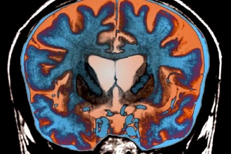 Болезнь Хантингтона: как дефектные белки разрушают ядро нервной клетки