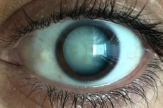 Прорыв в лечении катаракты: теперь это можно остановить