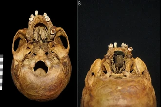 В Польше нашли 300-летний протез для неба из золота и меди