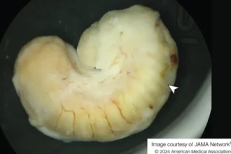 У женщины два года в глазу жил паразит. Возможно, виновато мясо крокодила