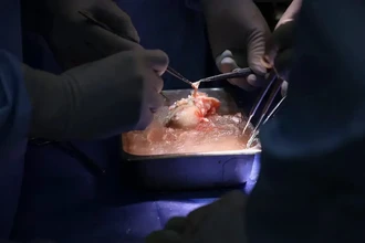 Человек со свиной почкой: как прошла первая в мире операция по пересадке