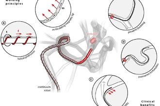 Магнитный робот-спасатель: как он очищает сосуды от тромба при инсульте
