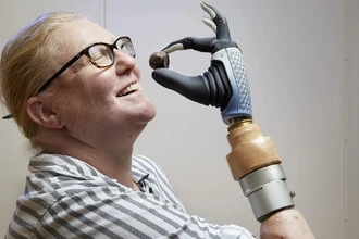 Бионическая рука стала продолжением тела: история пациента
