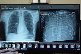 Как пациент выжил 2 дня без легких: искусственный орган как мост к трансплантации