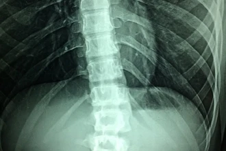 Прорыв в лечении паралича: как восстановили связи спинного мозга