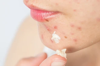 Новое нано-лечение угрей: как наразин в микроскопических капсулах побеждает акне